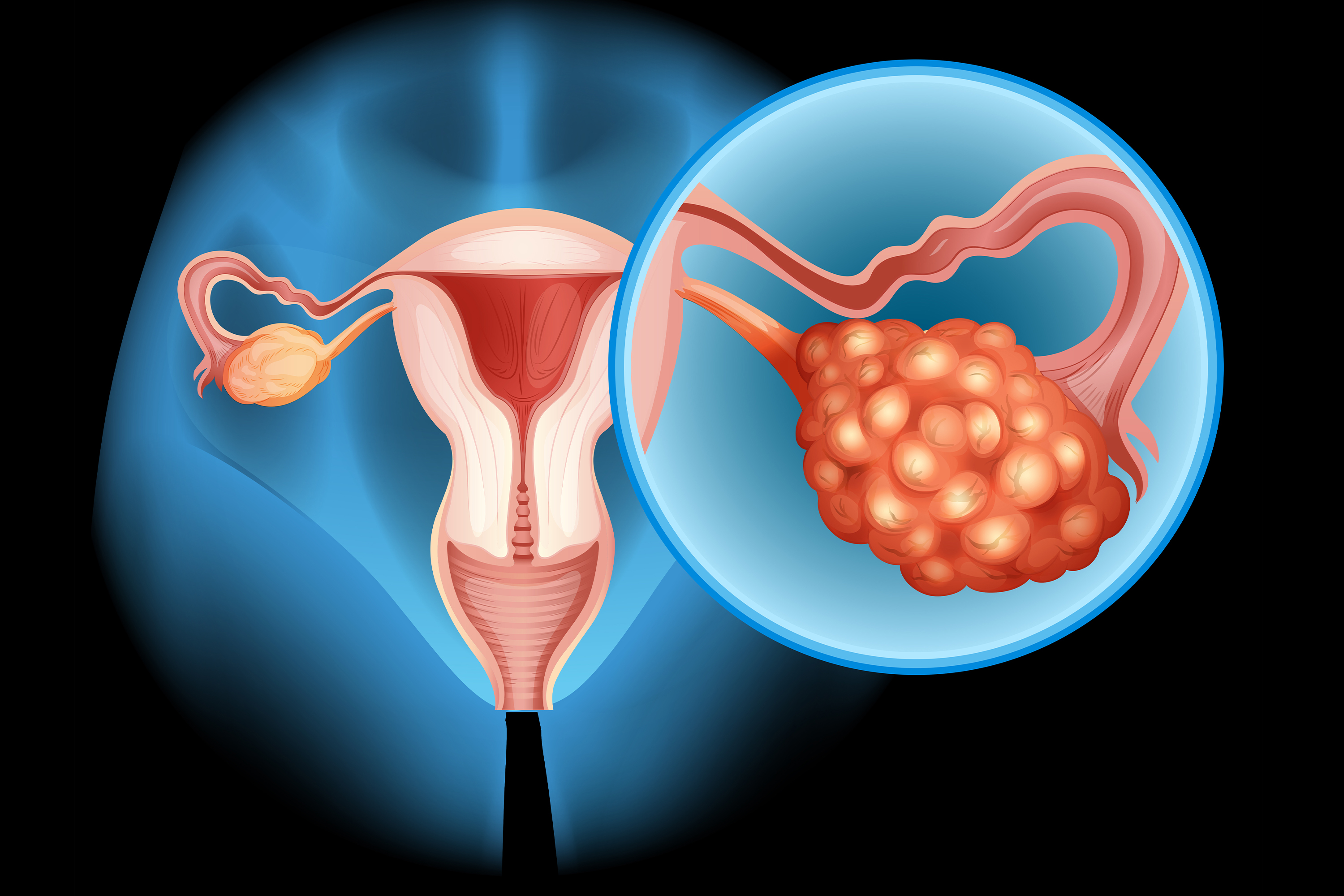 PCOS Treatment